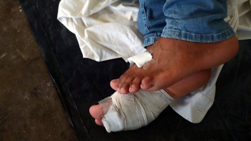 A migrant's bandaged feet