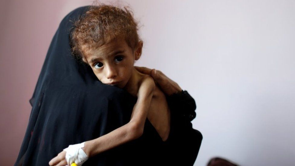 A woman holds a malnourished boy at the al-Sabeen hospital in Sanaa, Yemen (6 October 2018)