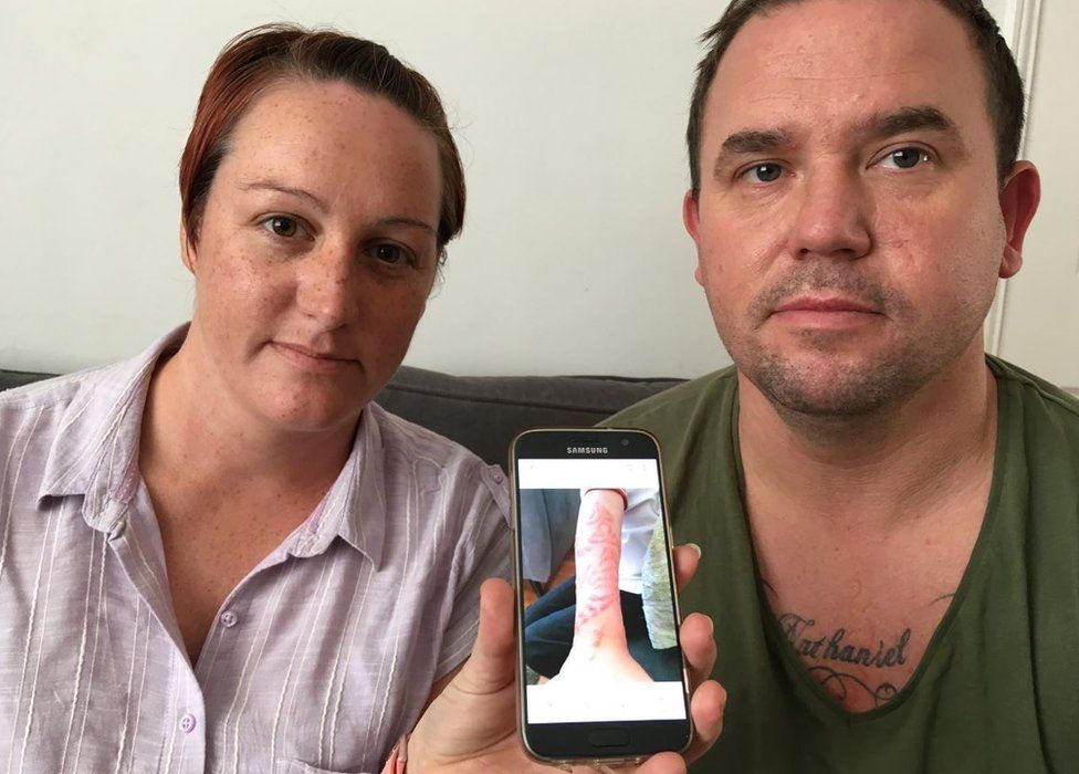 Tattoo-removal procedures leave clients 'horrified,' scarred for life | CBC  News