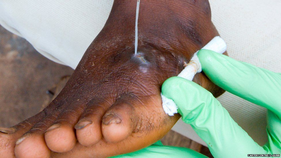 Guinea worm being pulled from foot
