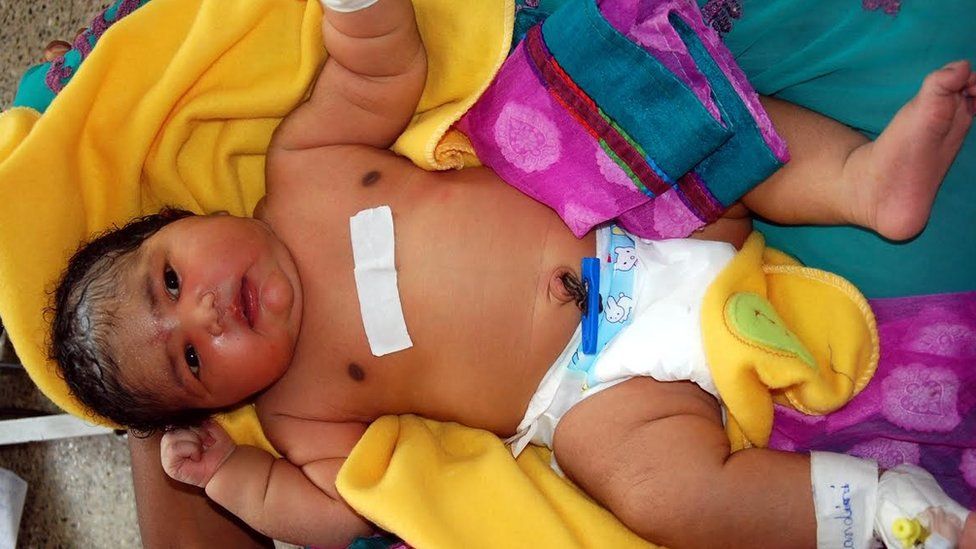 India's 'heaviest baby girl'