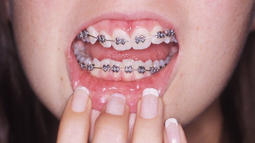 teeth braces