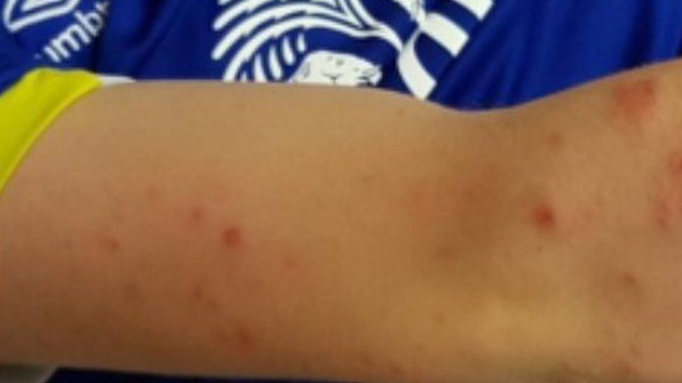 Cowpox lesions on the boy's arm