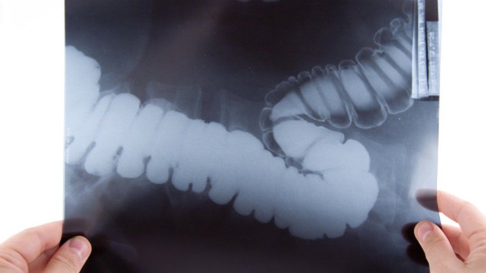 bowel x-ray