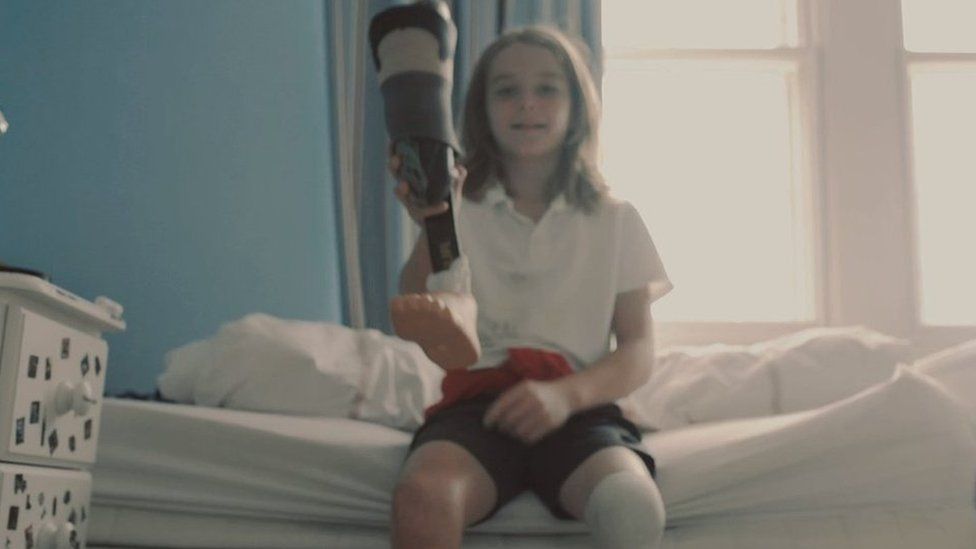 Euan with his prosthetic leg