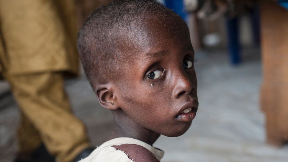 Мальчик, страдающий тяжелым недоеданием, в одной из диетологических клиник ЮНИСЕФ в Муне на окраине Майдугури, столицы штата Борно на северо-востоке Нигерии. 30 июня 2016 г.