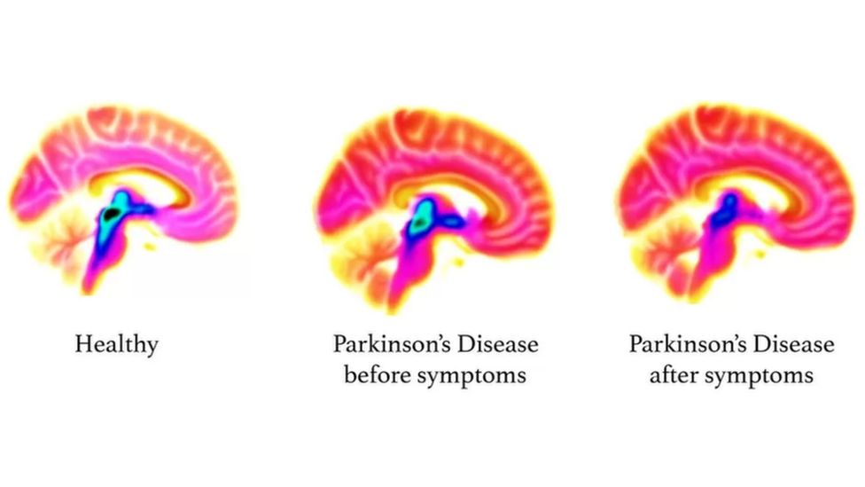 Parkinson's graphic