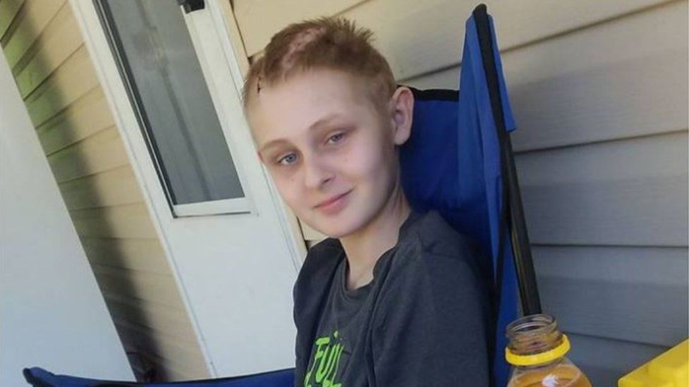 Missouri boy, 10, survives being impaled in the face by a metal meat skewer