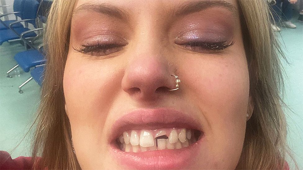 Селфи Ригана со сломанным зубом