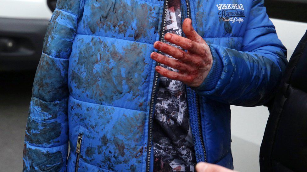 An injured victim with a bleeding hand talks after an explosion at Tekhnologichesky Institute metro station in St Petersburg