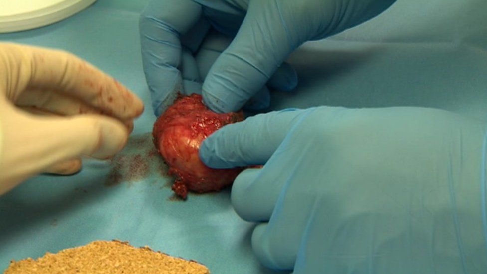 prostate gland removal surgery