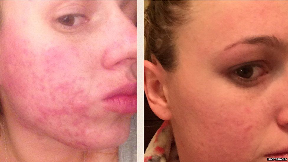 Lucy suffered with acne for three years.