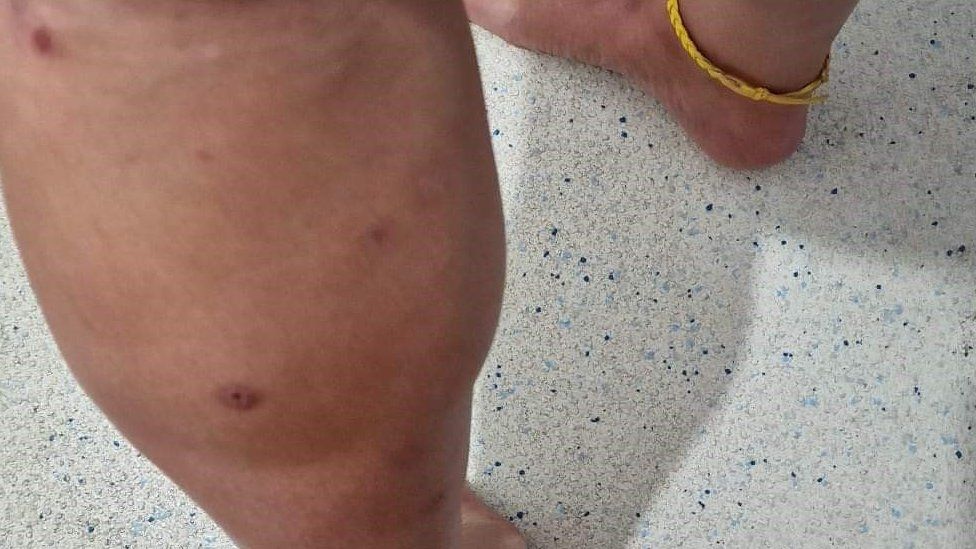 A woman's leg covered in bites