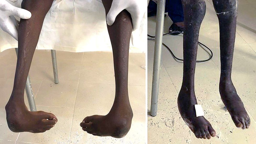 Changing The Lives Of Senegalese People Disabled By Clubfoot c News