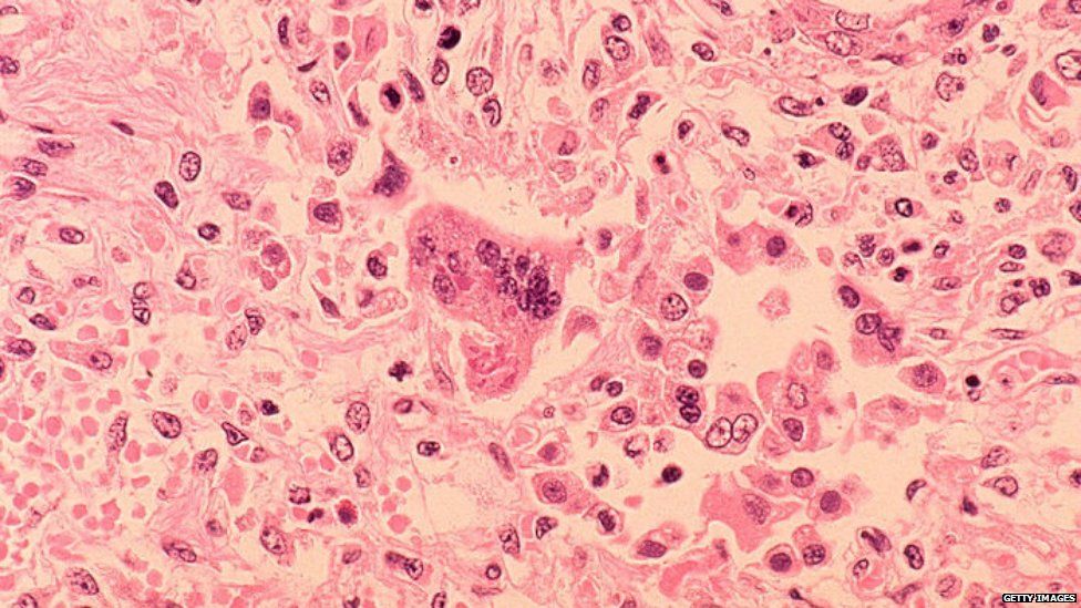 A handout image from the Centers for Disease Control and Prevention of measles viewed through a microscope in 1972