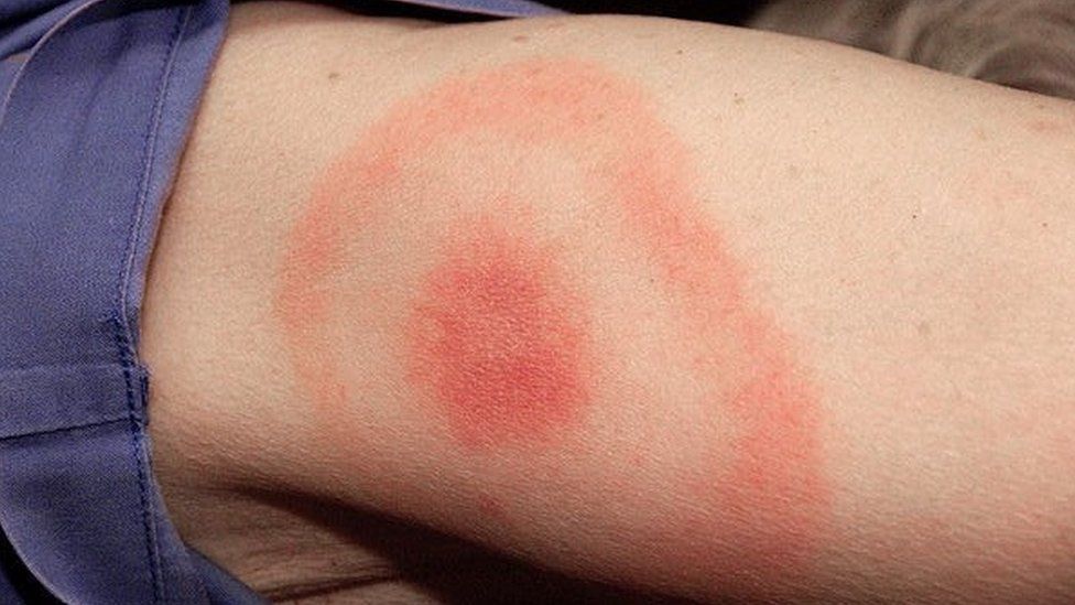 Small erythema migrans lesion with a central clearing and ‘bull’s eye’