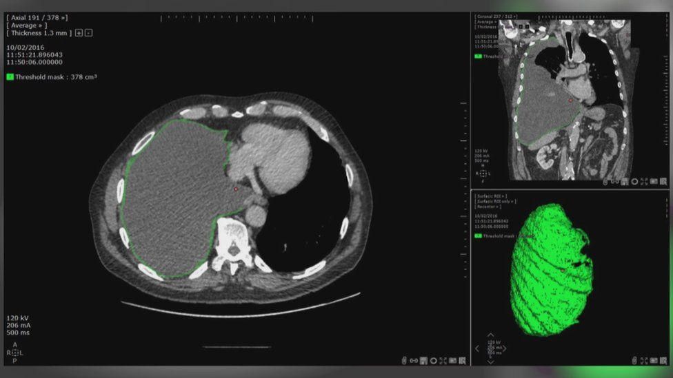 Imaging of tumour on lungs