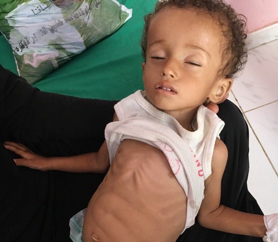 If you remember nothing of #Yemen remember Hussein Mazen Hussein - malnourished and fighting for every breath