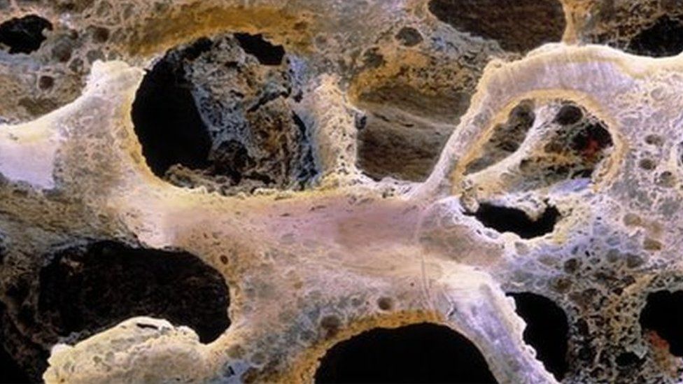 A bone with osteoporosis