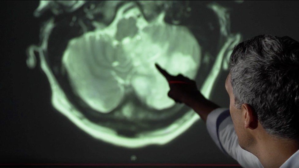 Consultant neurologist Arvind Chandratheva points out brain damage on a scan