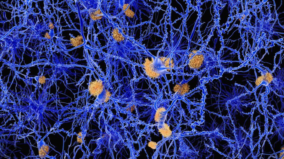 Amyloid plaques in Alzheimer's
