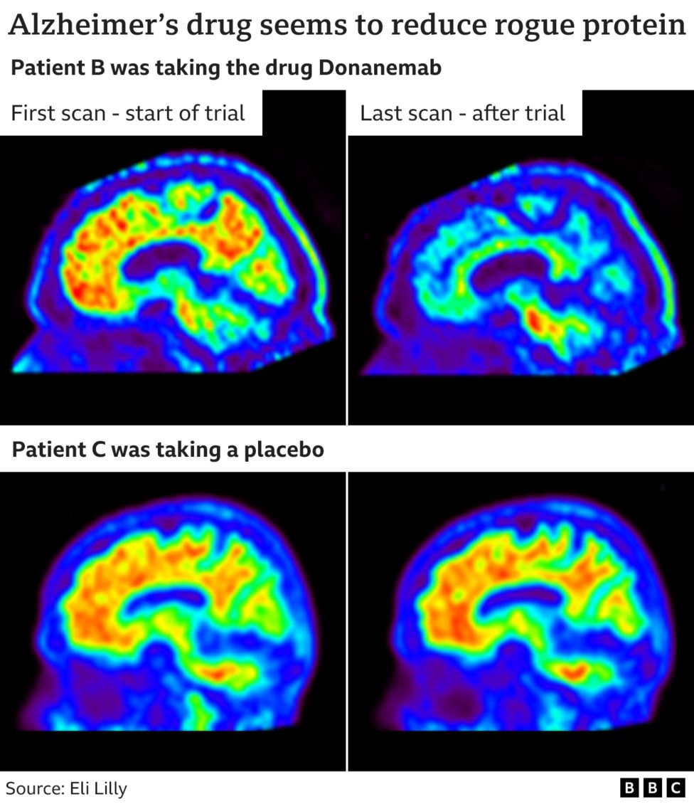 Drug Donanemab Seen As Turning Point In Dementia Fight - BBC News