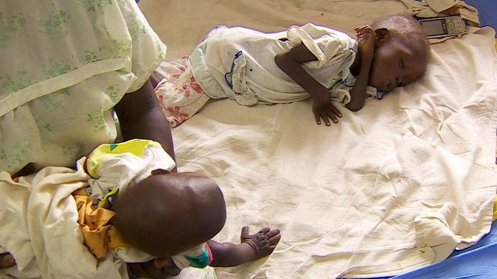 Children suffering from malnutrition in South Sudan