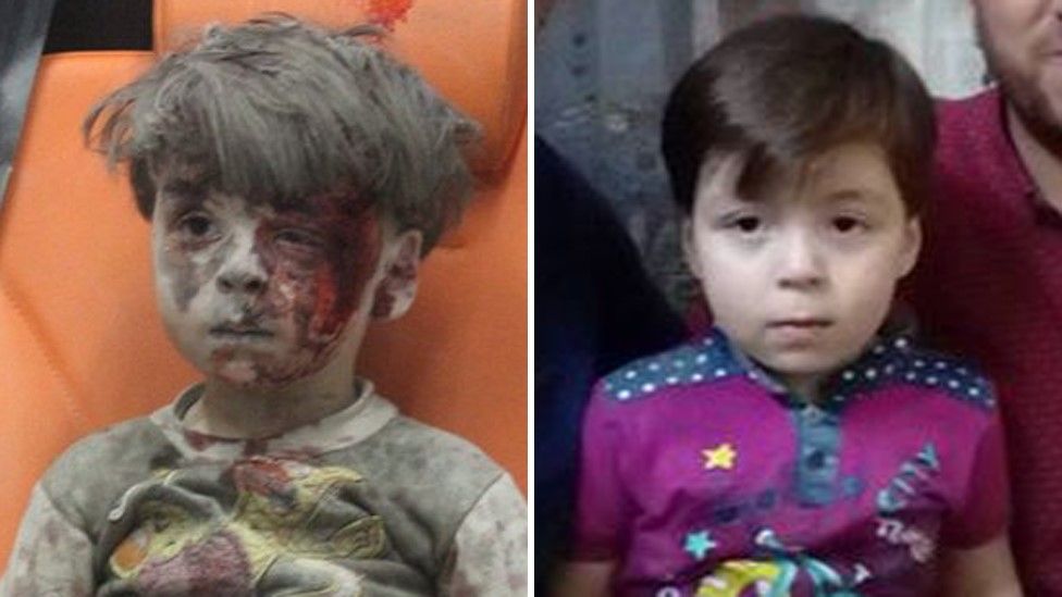 Photographs showing Omar Daqneesh after a reported air strike in Aleppo in August 2016, and in his home in Aleppo in June 2017