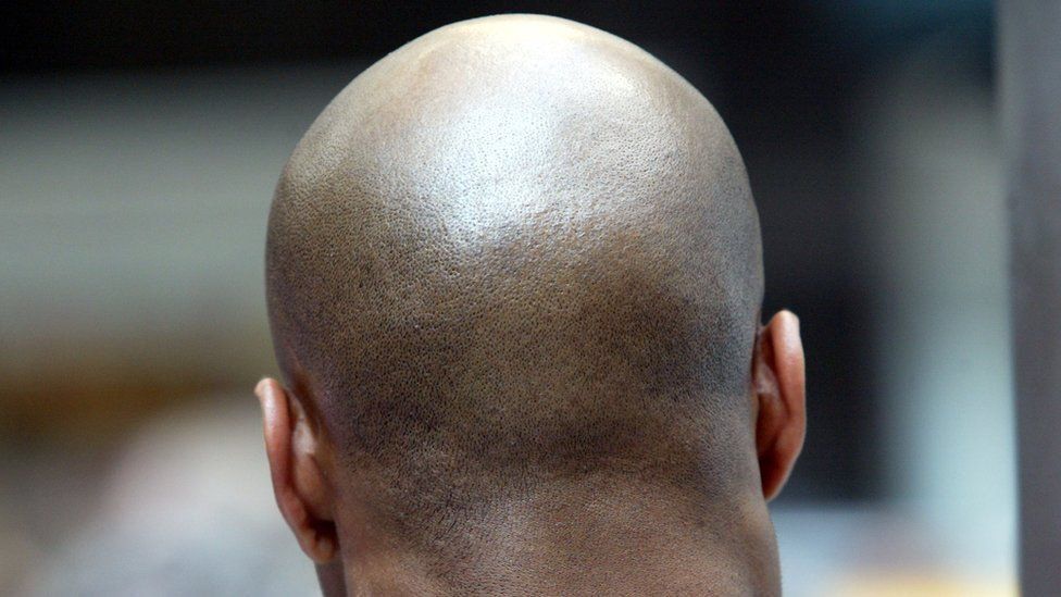 Steroid use can cause baldness