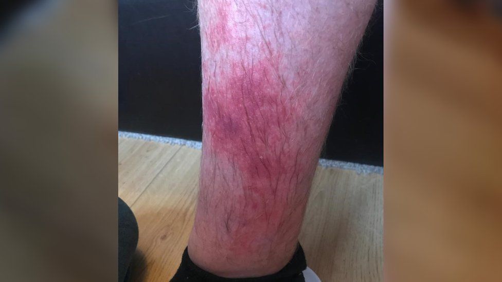 The burn on Olly's leg