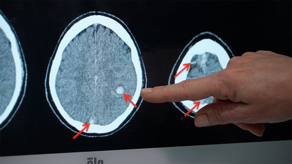 Профессор Скалли указывает на снимки МРТ, показывающие тромбоз мозга, связанный с вакцинацией