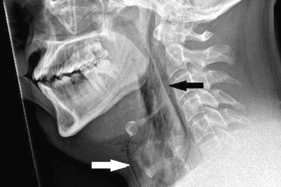 X-ray of the patients neck