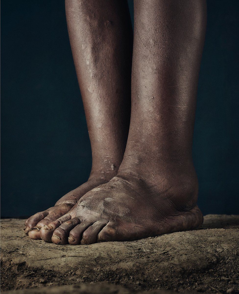 The feet of someone who suffers from podoconiosis