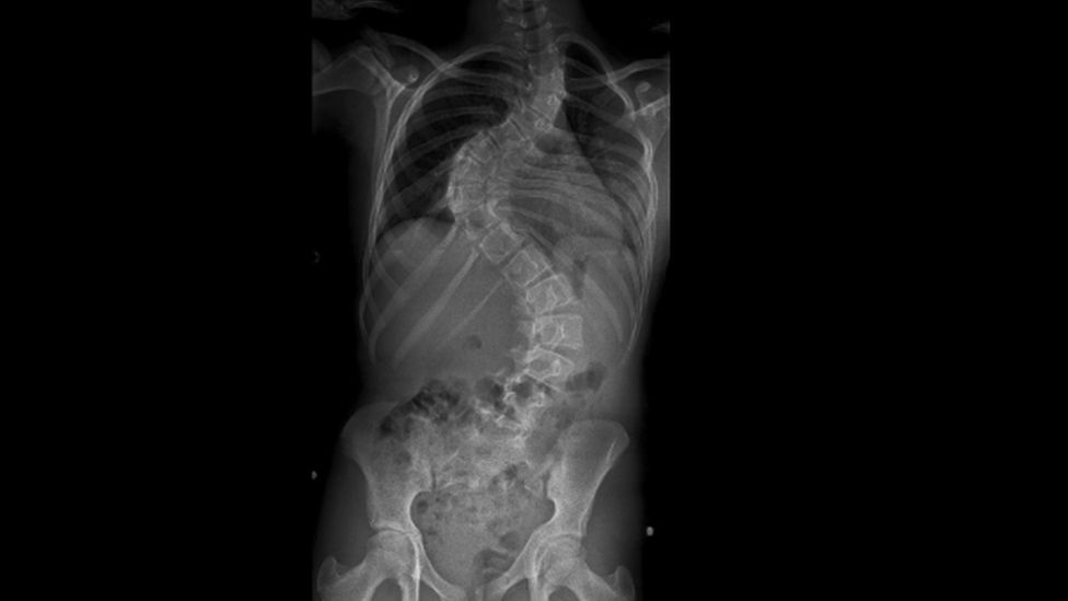 Megan's spine x-ray