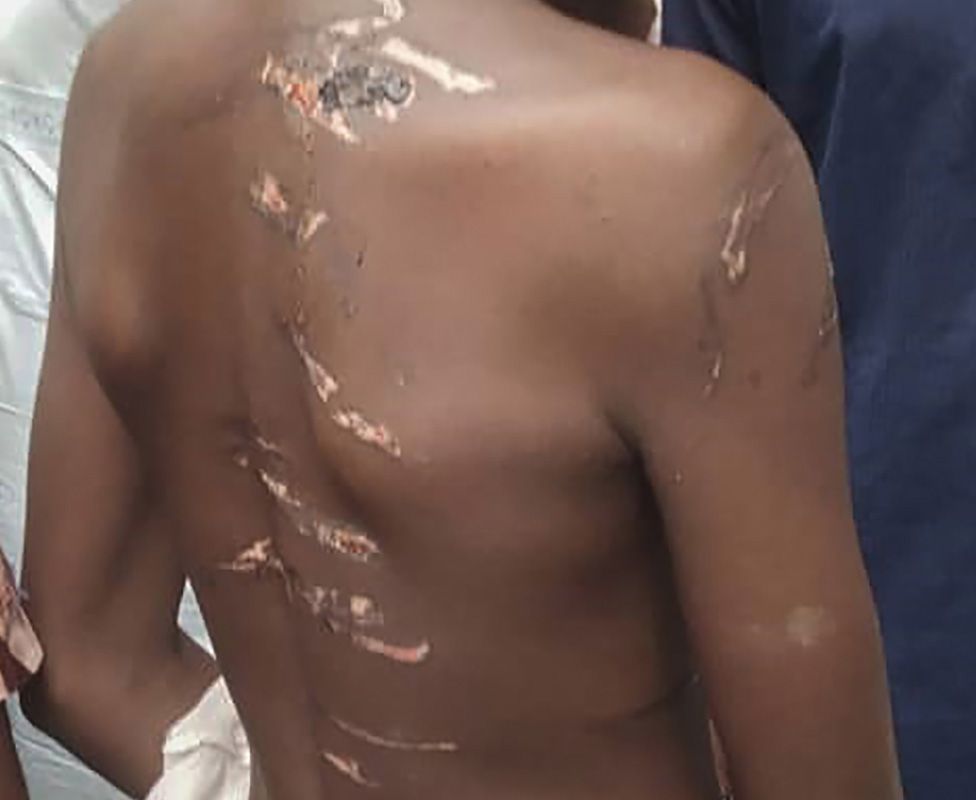 A boy shows his marks of torture pictured on September 26, 2019 in the Rigasa area of Kaduna