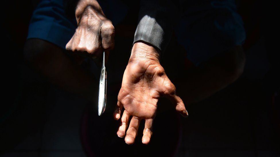 In this photograph taken on March 11, 2015, cured leprosy patient Shiv Shankar Tiwari, 62, cleans his clawed hands in a leprosy colony in New Delhi