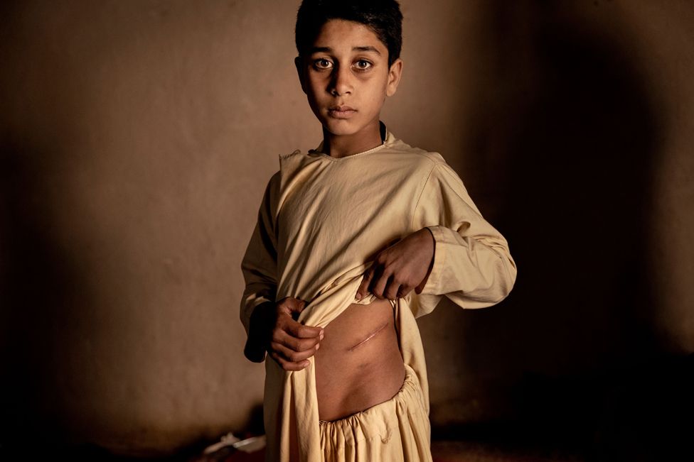 Khalil Ahmad (15) shows his scar from an operation to remove his kidney