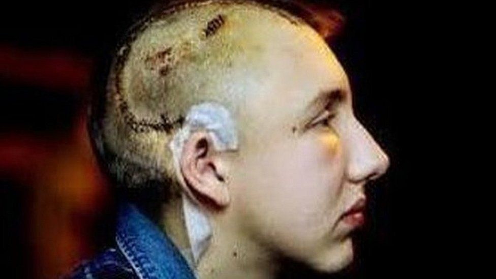 Alfie Meadows needed more than 100 staples in his head and was left with a large scar