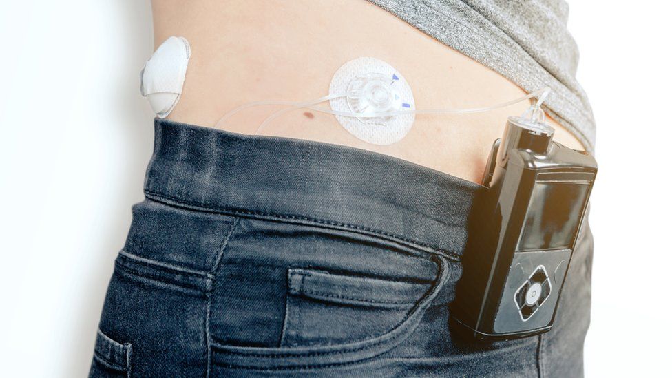 The technology involves an insulin pump, continuous glucose monitor and an algorithm to calculate the amount of insulin needed