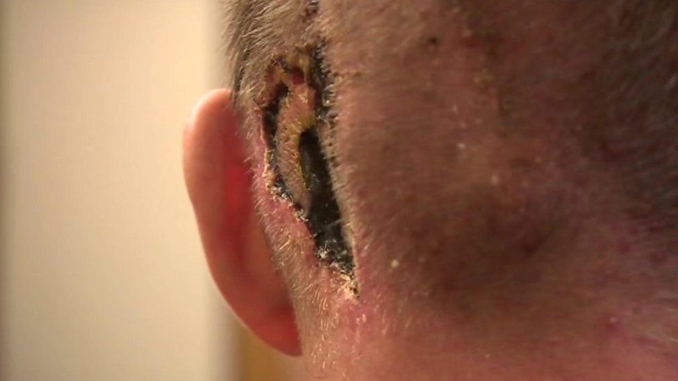 Chris Bryant's scar