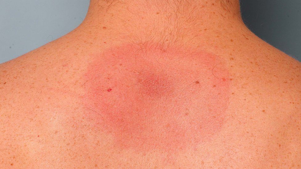 Lyme disease "bullseye" rash