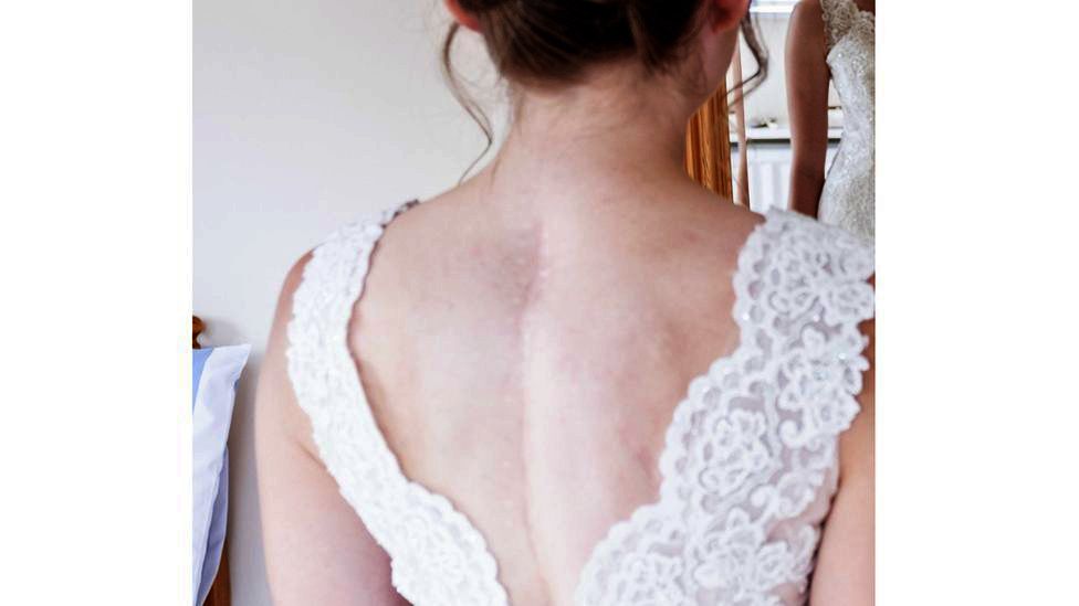 Princess eugenie wedding clearance scar