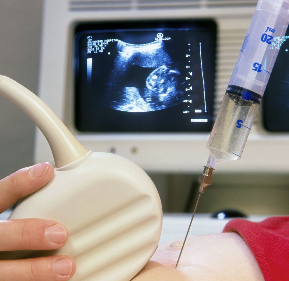 Ultrasound-guided amniocentesis