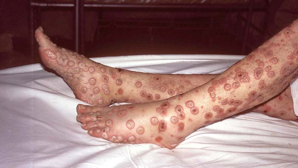Spots on Janet Parker's leg