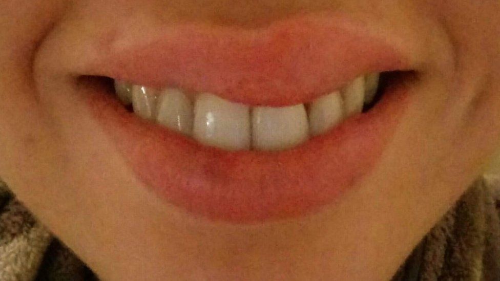 Lip fillers 'Perfect storm' due to lack of regulation BBC News