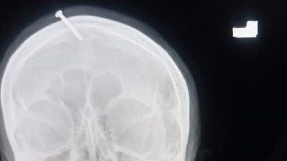 An x-ray of the nail stuck through the woman's head