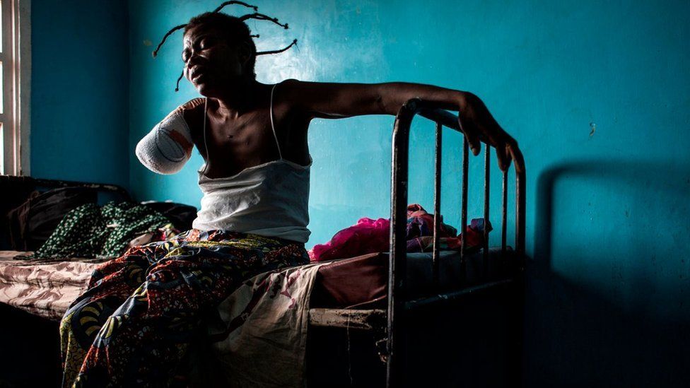 A Congolese women, who has had her arm amputated after a gun shot wound, sits on her bed on October 23, 2017 in Tshikapa