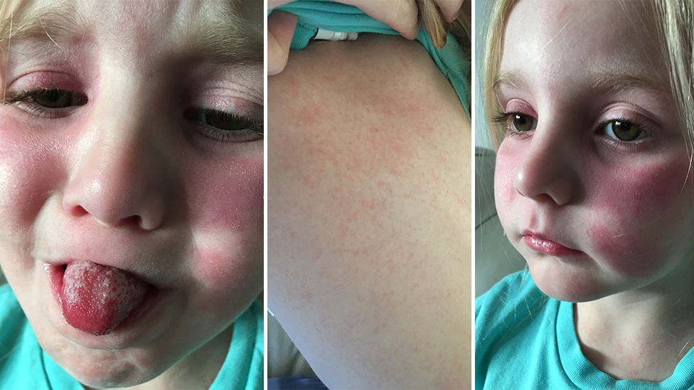 What is Scarlet Fever?