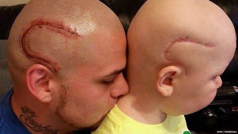 Kansas dad gets a tattoo to match his son's brain cancer surgery scar - BBC  News