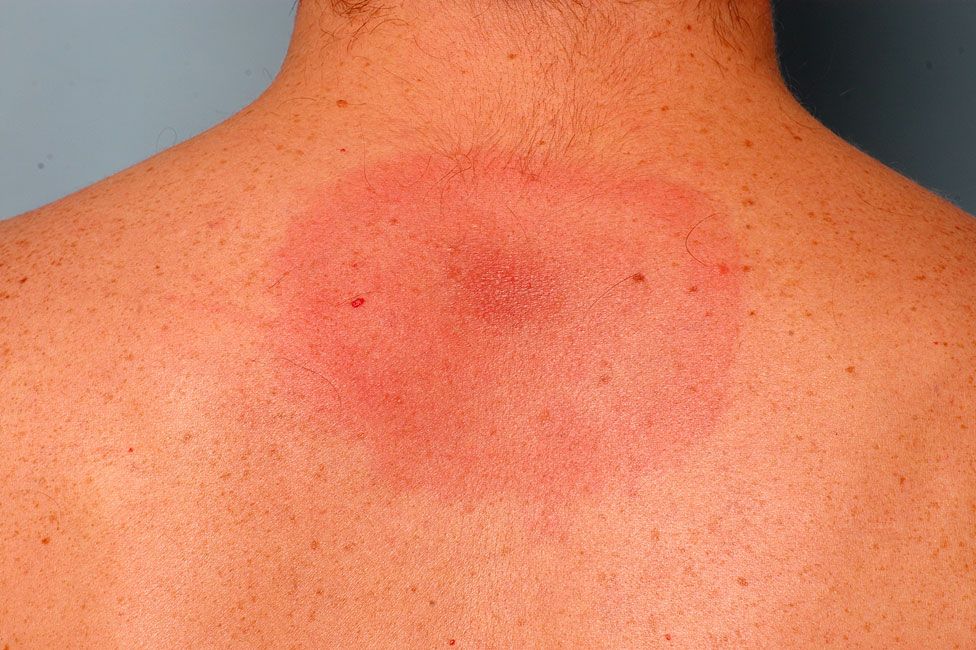 Rash from a tick carrying Lyme disease